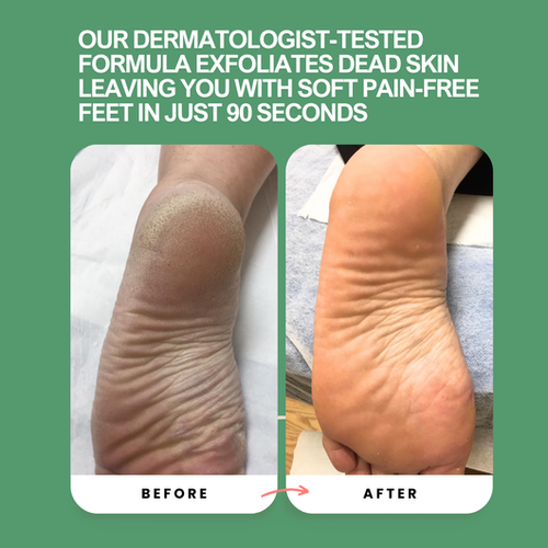 Peele™ Instant Foot Peeling Cream